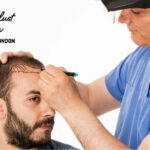 Top 5 Best Hair Transplant Clinics in London